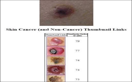 Skin Cancer Image Search thumbnail